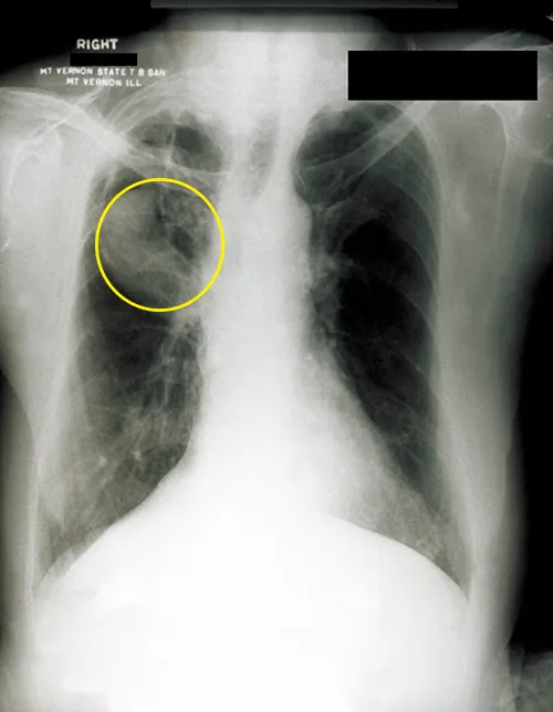 An X ray showing white bones on a black background. White webbing in the upper lung is circled.