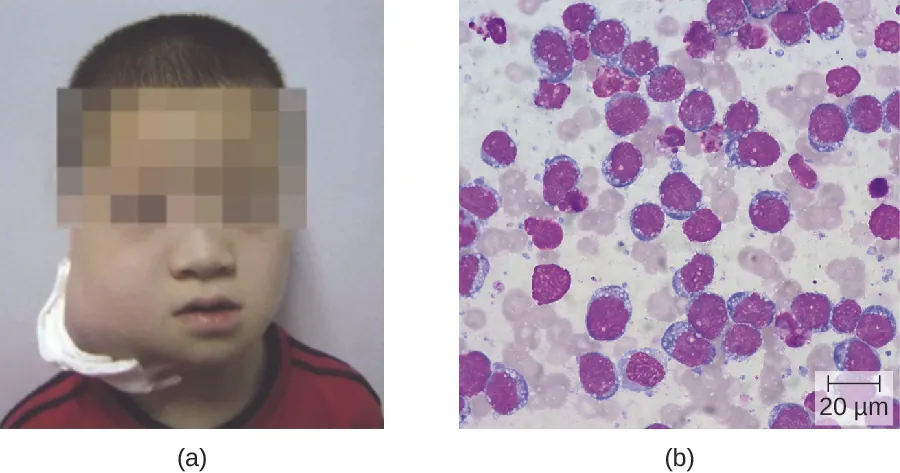 a) photo of a child with a very large swelling on the side of the neck. B) micrograph of a blood smear with a lot of white blood cells that are oddly shaped with white spots.