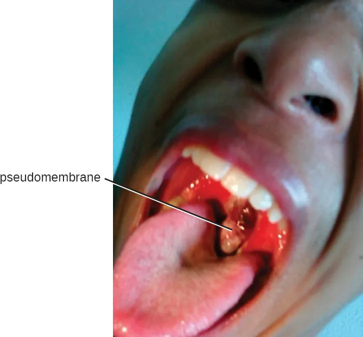 A gray, leathery blob in the back of a person’s mouth is shown and the label “pseudomembrane” points to it.