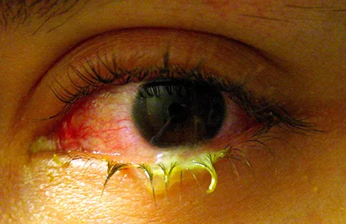 Eye with yellow discharge.