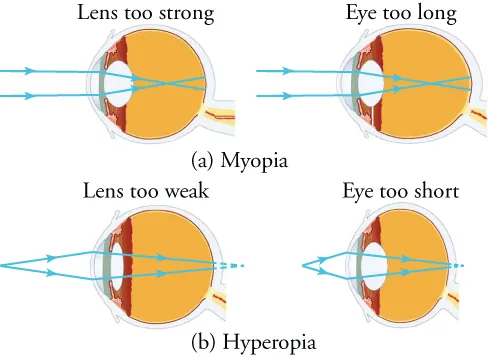 View (a) shows schematic cross-sections of the eye indicative of myopia. View (b) show schematic cross-sections of the eye indicative of hyperopia.