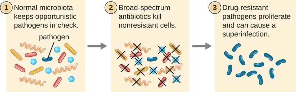 Diagram of process of superinfection. 1: Normal microbiota keeps opportunistic pathogens in check. Image shows many different bacteria, only 1 of which is labeled pathogen. 2: Broad-spectrum antibiotics kill nonresistant cells. Image shows all cells but pathogen being killed. 3: Drug-resistant pathogens proliferate and can cause a superinfection. Image shows many of the pathogen.