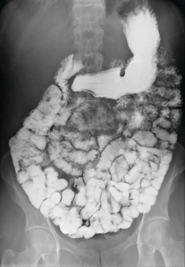 This figure contains one image. A black and white abdominal x-ray image is shown in which the intestinal tract of a person is clearly visible in white.