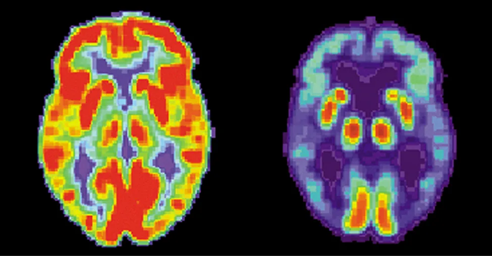 Pokazano dwa obrazy mózgu. Ten po lewej stronie ma wiele czerwonych i pomarańczowych obszarów oraz trochę niebieskich obszarów. Ten po prawej stronie jest głównie niebieski z bardzo małymi obszarami w kolorze czerwonym i żółtym.