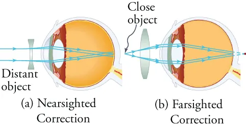 View (a) shows a schematic cross-section of the eye and a concave lens that corrects for nearsightedness. View (b) shows a schematic cross-section of the eye and a convex lens that corrects for farsightedness.