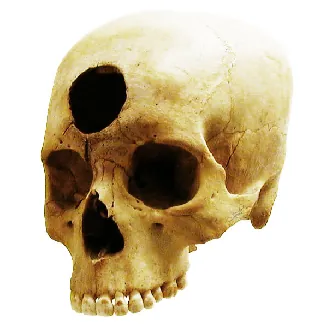 A skull has a large hole bored through the forehead.