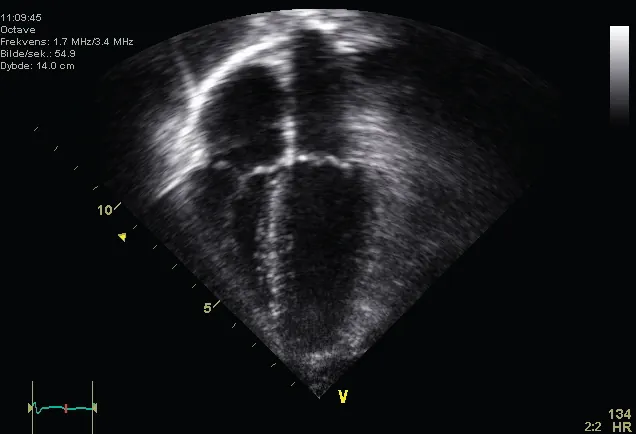 This is an ultrasound picture of a normal heart showing all 4 chambers.