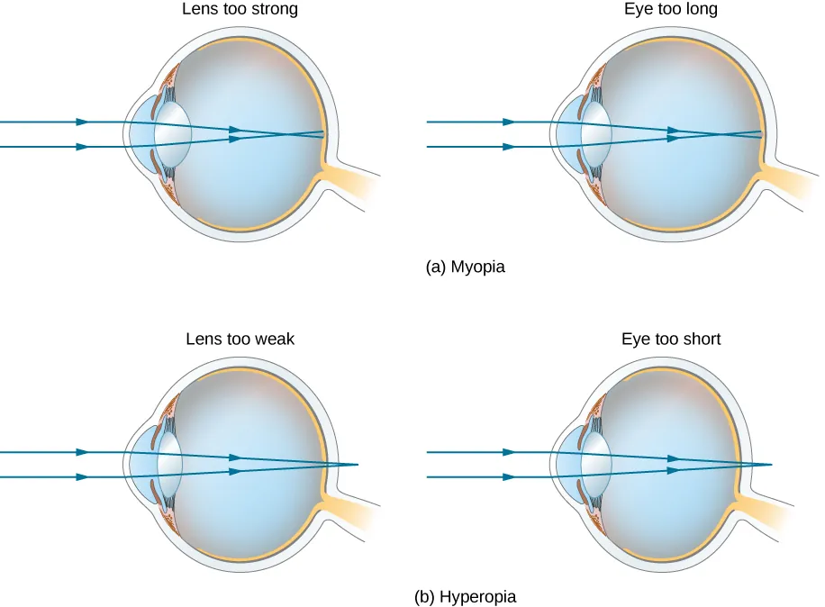 Figure a shows two eyes labeled “lens too strong” and “eye too long”. In both cases, parallel rays striking the cornea converge in front of the retina. Figure b shows two eyes labeled “lens too weak” and “eye too short”. In both cases, parallel rays striking the cornea converge behind the retina.
