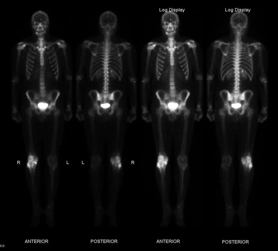This figure shows four images of a skeleton of a human. Different parts of the body show bright spots wherever the bone cells are most active, indicating bone cancer.