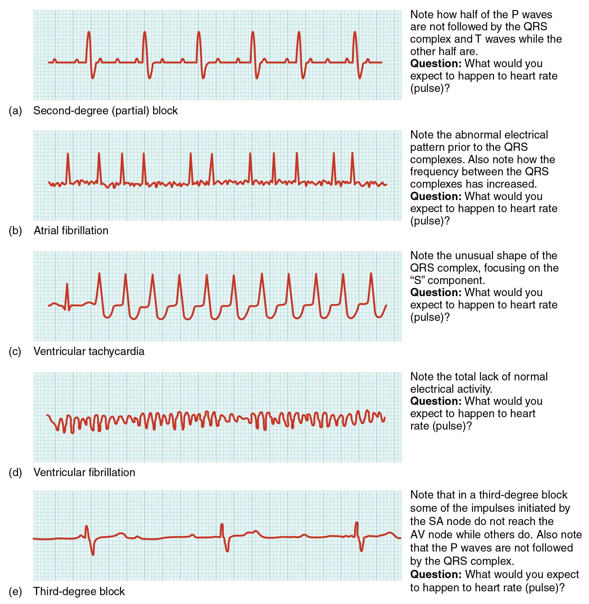 In this image the QT cycle for different heart conditions are shown. From top to bottom, the arrhythmias shown are second-degree partial block, atrial fibrillation, ventricular tachycardia, ventricular fibrillation and third degree block.