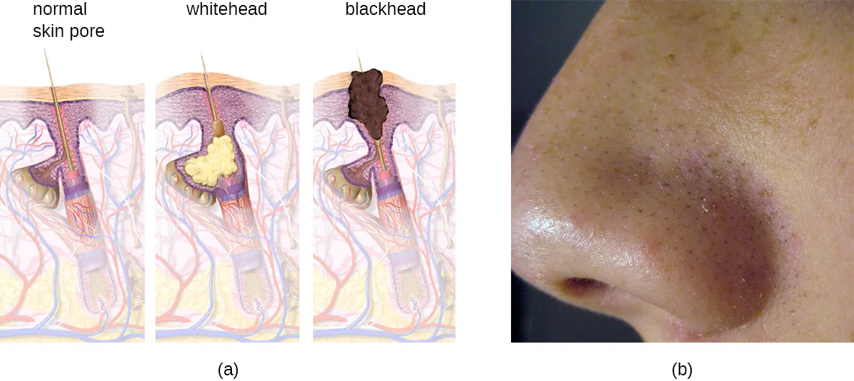 a) diagram of blackhead formation. A normal pore in the skin becomes filled with material forming a whitehed. Darker material forms a blackhead. B) blackheads on a nose.