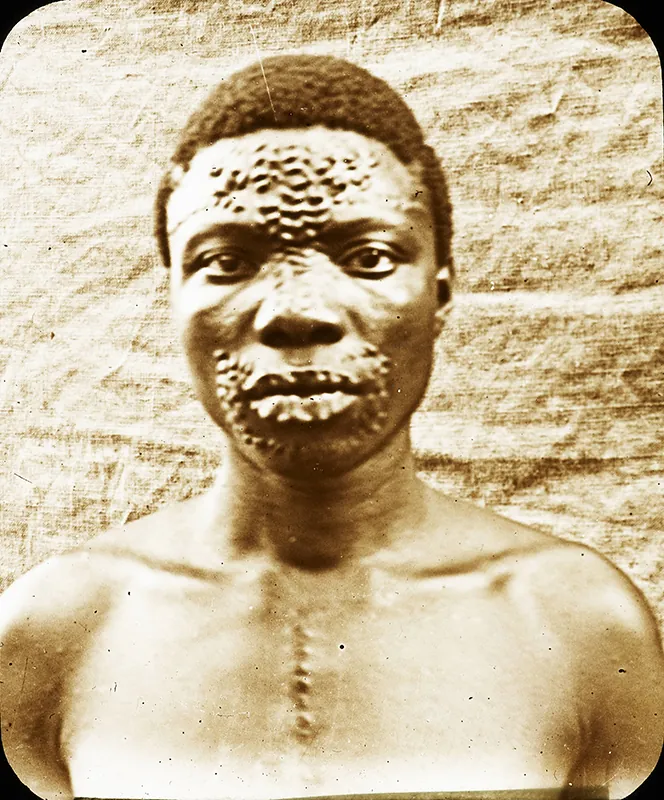 Man with many scars on his forehead and around his mouth. The scars form recognizable patterns.