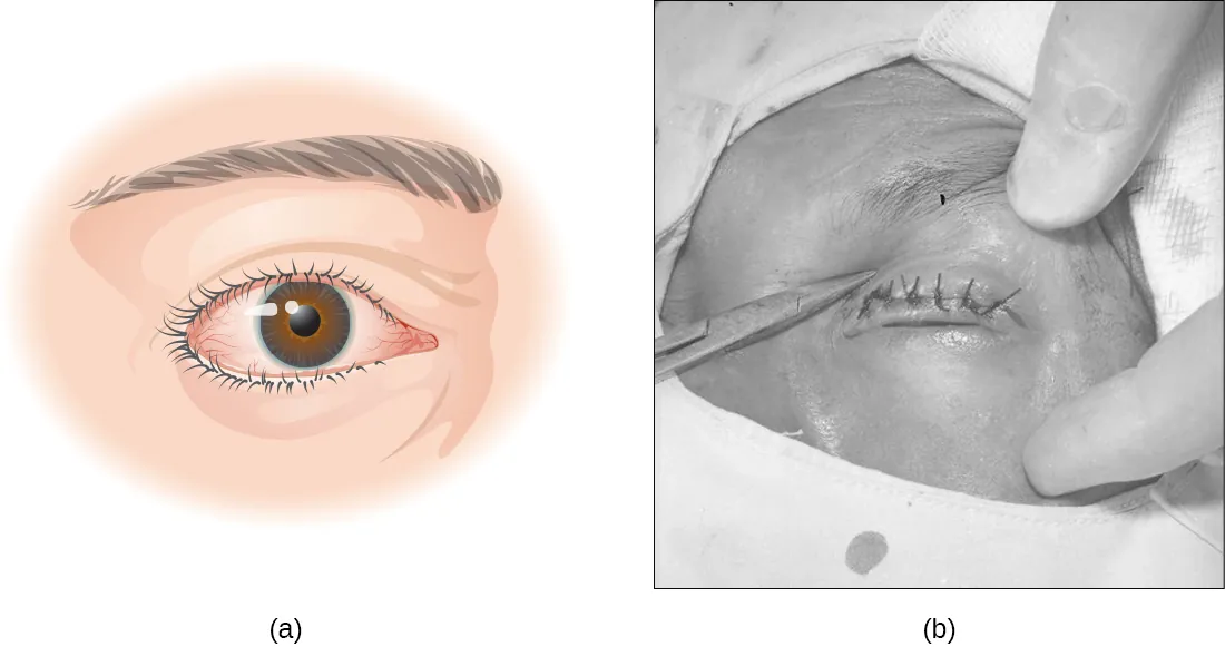 a) eye with turned in eyelids. B) photo of eye surgery.
