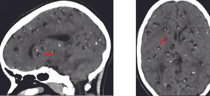 Brain scans with small lumps (look like pimples) indicated by arrows.