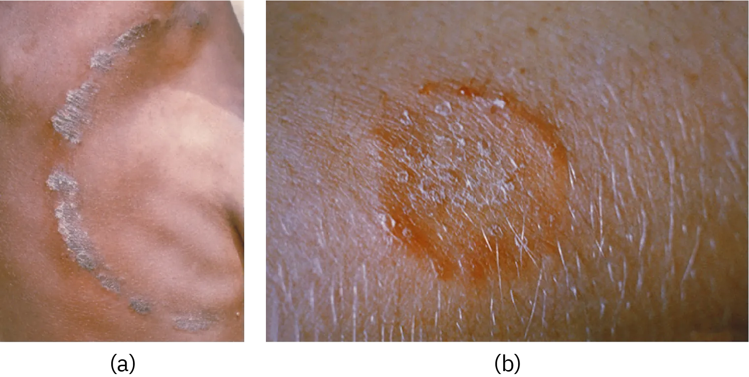 Two photos of a rash on skin, the first of a large raised grayish ring, and the second of a raised red ring.