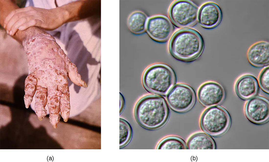 a) Large crusty legions on a deformed hand. B) A micrograph of round cells.