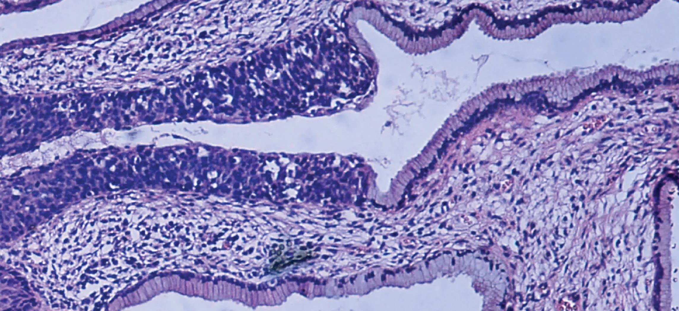 This micrograph shows tissue surrounding several empty spaces. The epithelial tissue occurs at the border between the rest of the tissue and the empty spaces. The normal epithelium is composed of rectangular-shaped cells neatly organized side by side. Dark purple nuclei are clear at the bottom of the epithelial cells, where they attach to the rest of the tissue. The abnormal epithelium appears as a tangled area of purple nuclei, much thicker than the normal epithelium although no distinct cells are discernible.