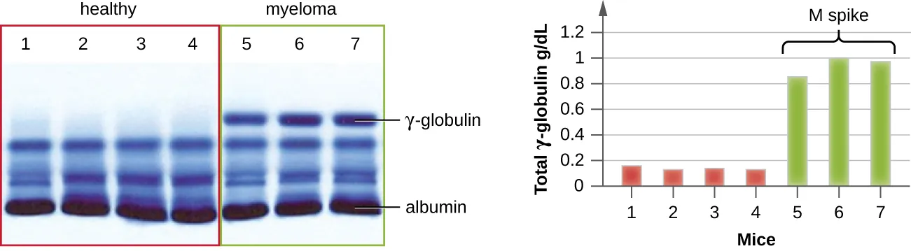 Electrophoresis showing 4 healthy patterns and 3 examples of those with myeloma. All 7 lanes contain multiple blue bands with a thick band labeled albumin. The myeloma samples have a dark band labeled gamma-globulin, while the healthy samples do not have a band here. A graph showing the total gamma-globulin amount (g/dl) in each of these samples. The healthy samples have approximately 0.1 while the myeloma samples range from 0.8 to 1.