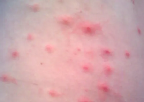 Skin with red raised bumps.