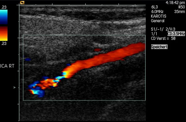 Doppler-shifted ultrasonic image of a partially occluded artery.