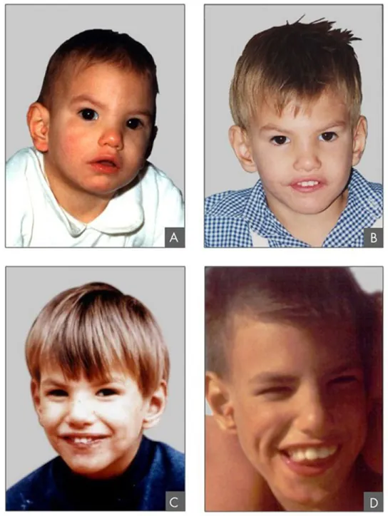 Photo shows boy with cri-du-chat syndrome at four different ages (ages two, four, nine, and twelve).