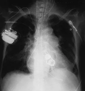 This figure is an X-ray of a person's chest cavity. It includes the outlines of artificial heart valves, a pacemaker, and some wires.
