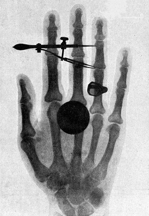 An x-ray image of Bertha Röentgen’s hand is shown with a dark circular spot superimposed on the fingers.