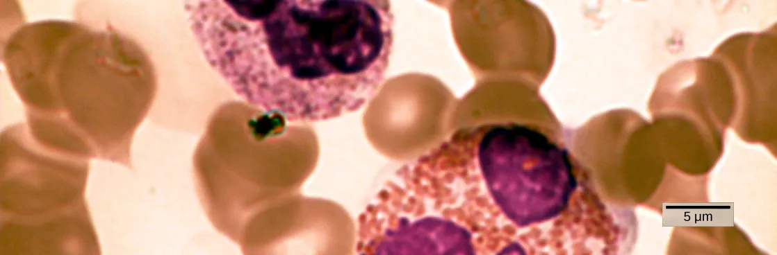 Micrograph shows a blood smear. The neutrophil and eosinophil are similar in structure, but the eosinophil is larger. Both are filled with granular structures, and have three purple-stained nuclei. These white blood cells are surrounded with donut-shaped red blood cells.