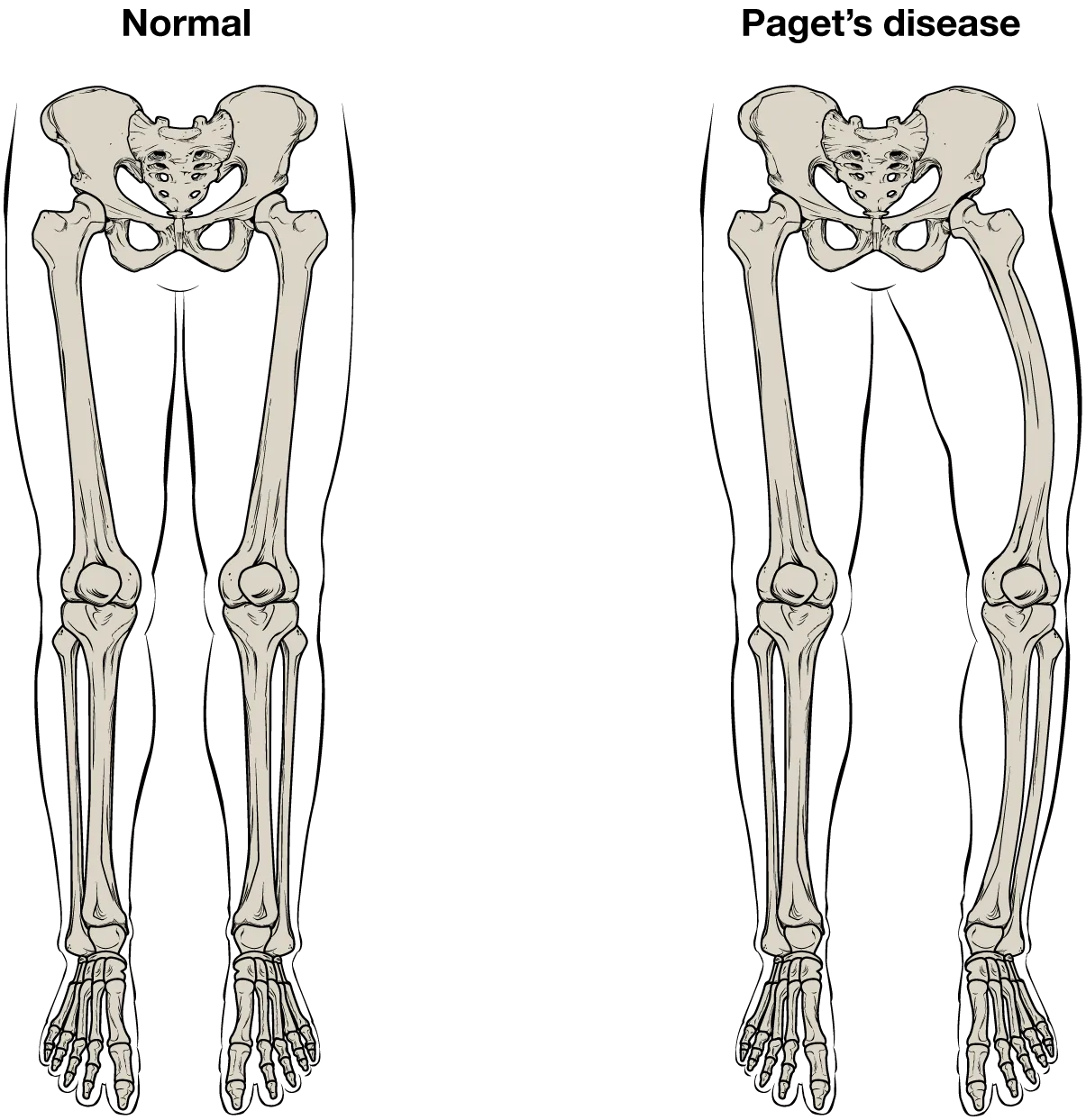This illustration shows the normal skeletal structure of the legs from an anterior view. The flesh of the legs and feet are outlined around the skeleton for reference. A second illustration shows the legs of someone with Paget’s disease. The affected person’s left femur is curved outward, causing the left leg to be bowed and shorter than the right leg.