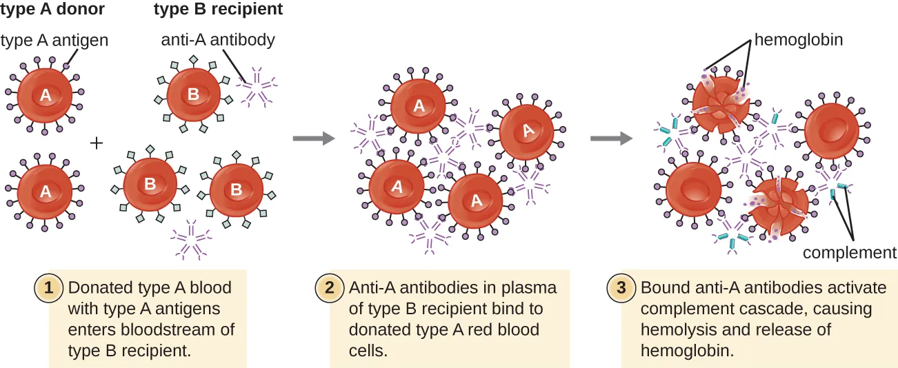 Diagram of a Type A donor giving blood to a Type B recipient. 1: Donated type A blook with type A antigens enters bloodstream of type B recipient. Red blood cells with Type A antigens and red blood cells with Type B antigens are shown; anti-A antibody is also present. 2: Anti-A antibodies in plasma of Type B recipient bind to donated type A red blood cells. 3: Bound anti-A antibodies activate complement cascade, releasing hemoglobulin and destroying red blood cells. Small dots are shown destroying type A cells.