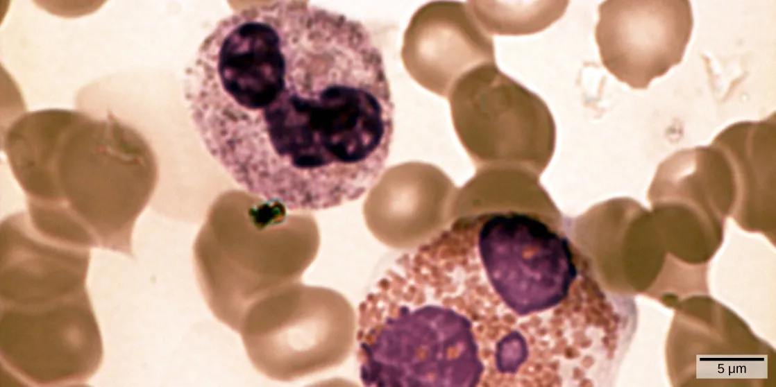Micrograph shows a blood smear. The neutrophil and eosinophil are similar in structure, but the eosinophil is larger. Both are filled with granular structures, and have three purple-stained nuclei. These white blood cells are surrounded with donut-shaped red blood cells.