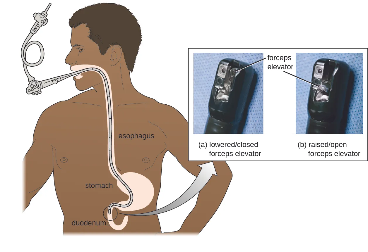 Diagram of a person with a duodenoscope inserted into their mouth – it travels through the esophagus and stomach to the duodenum. A photograph of the end of the scope shows a foreceps elevator in the lowered/closed and raised/open position.