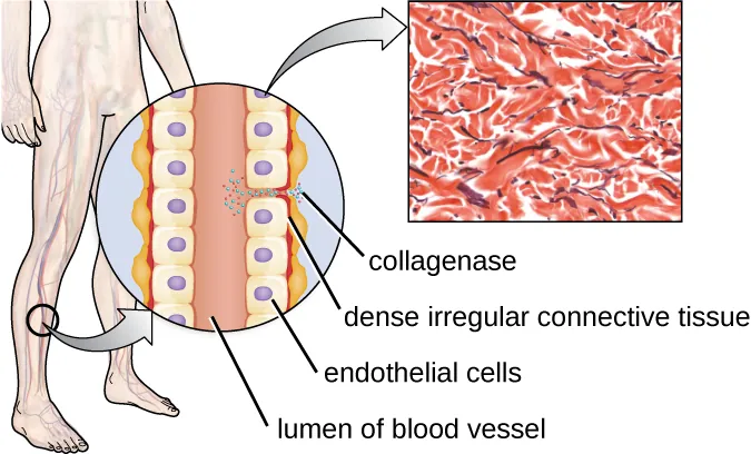 A diagram of a tube labeled lumen of blood vessel lined by cells labeled endothelial cells. Outside he cells is dense irregular connective tissue. Collagenase is shown as small dots that break up the connections between the cells. A micrograph of the dense connective tissue shows many red lines making a meshwork.