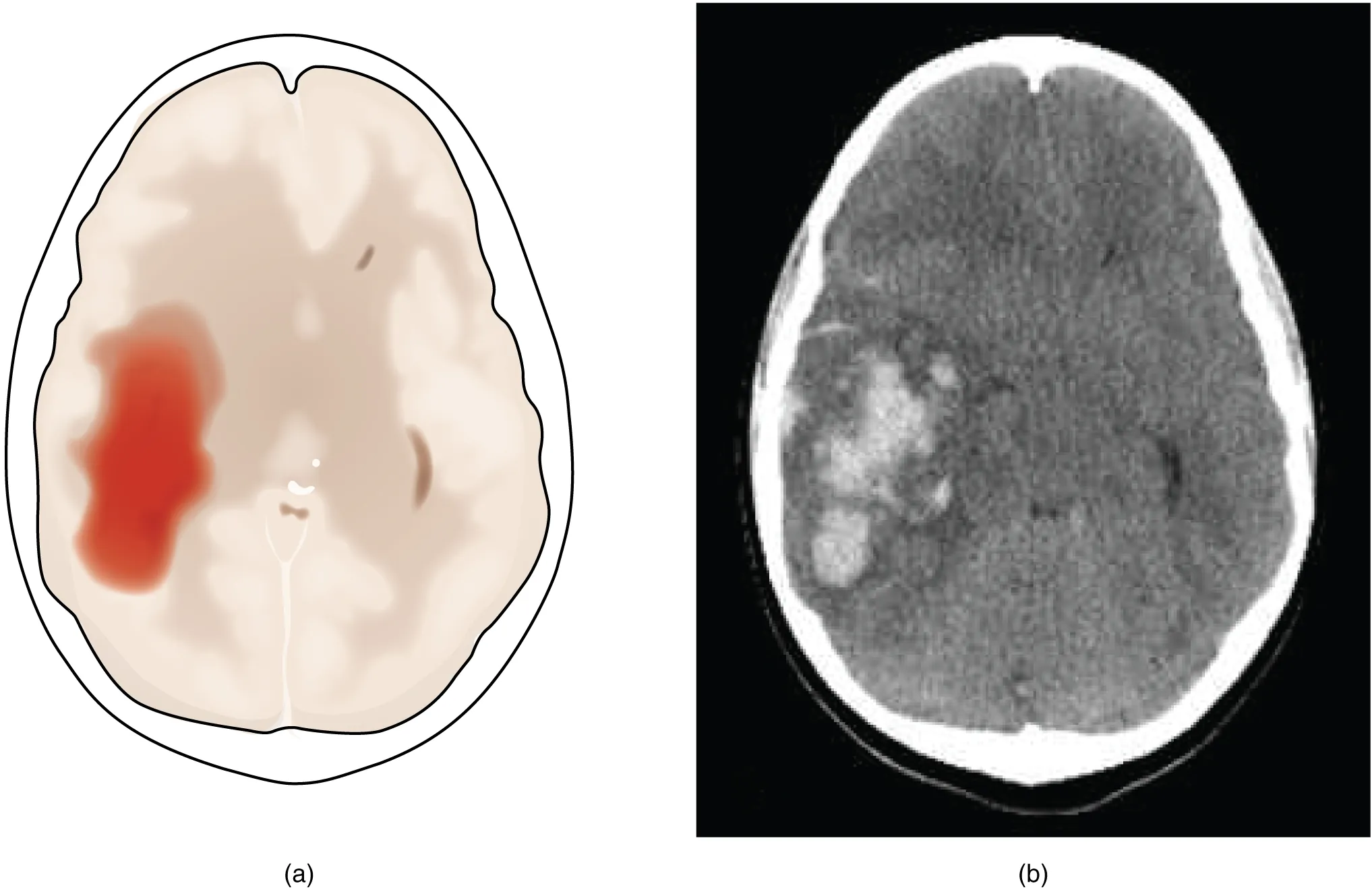 The left panel of this image shows an image of the brain with a region in red. Arrows pointing towards this region indicate a hemorrhage associated with a stroke. The right panel shows a hemorrhage as it might appear on a CT scan.