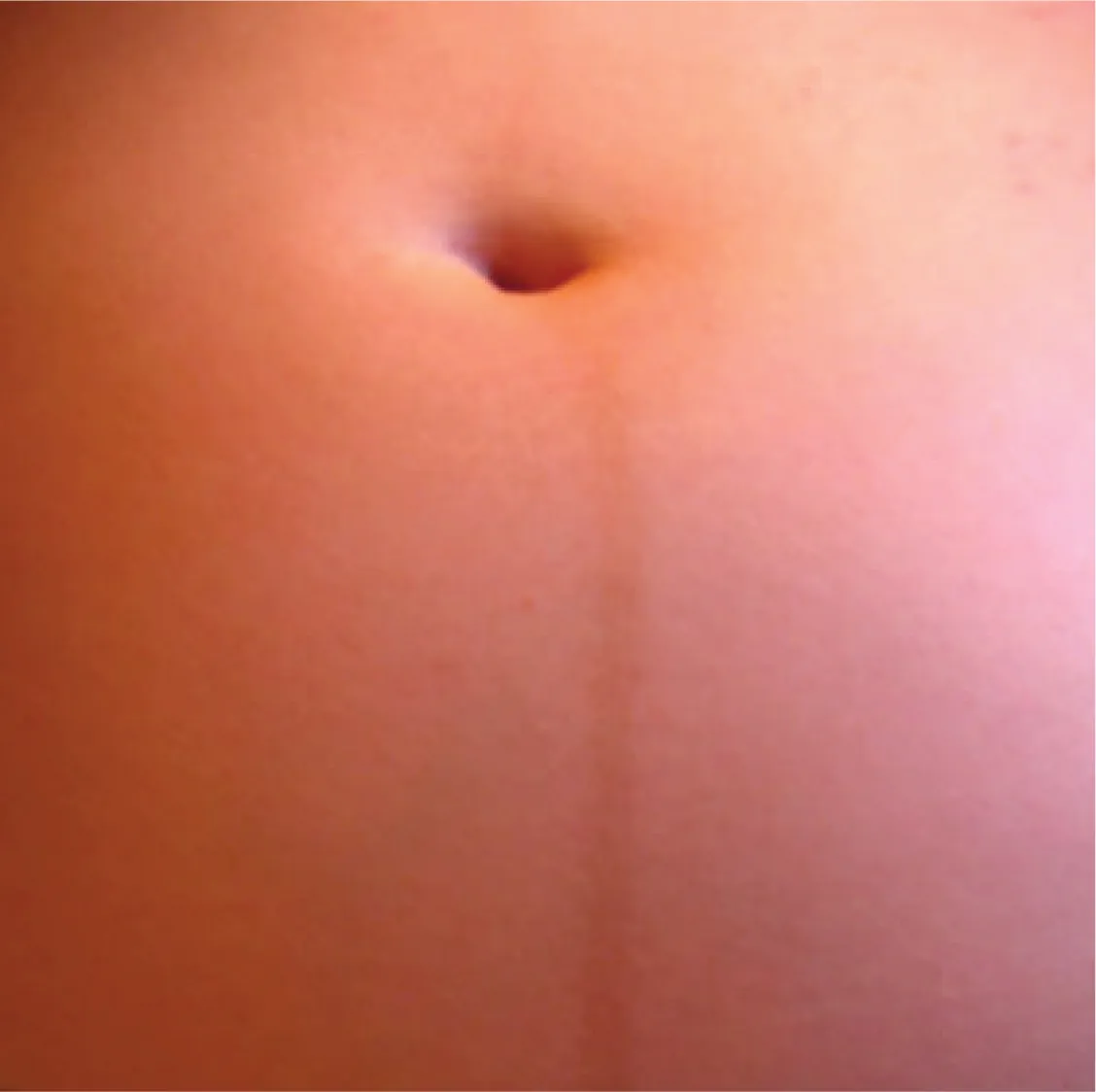 This photo shows a dark line below a woman’s navel.