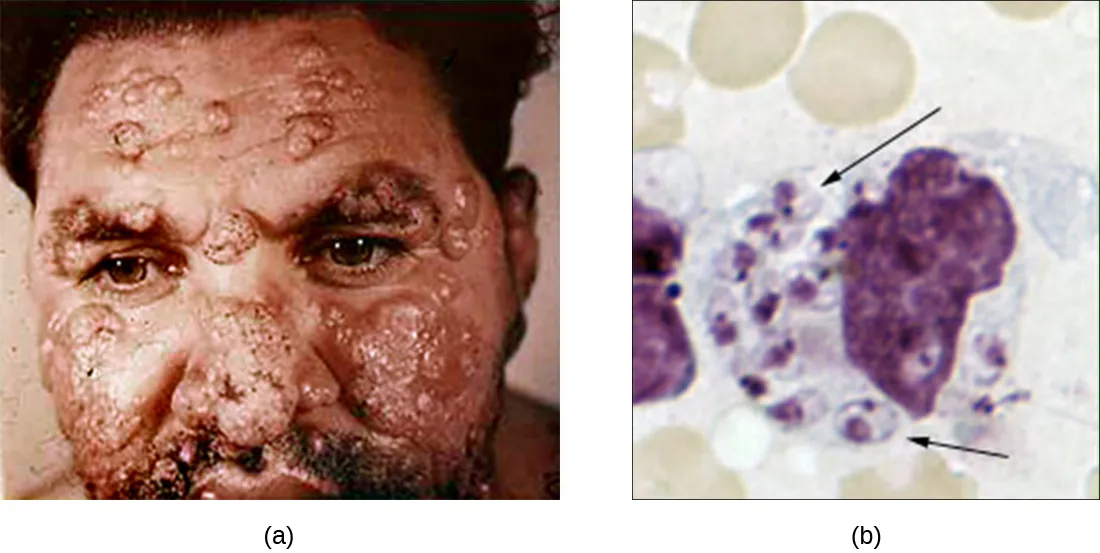 a) a photo of a man with large skin lesions covering his face b) A macrophage in a field of red blood cells. The macrophage has many smaller circles inside of it. Each of these has a distinct nucleus.