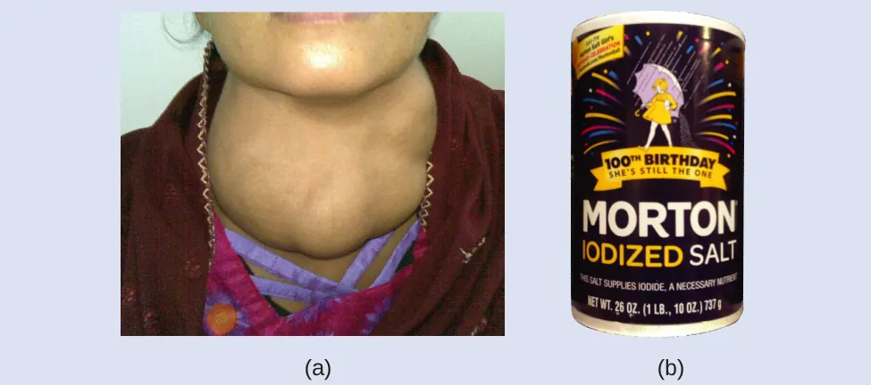 La figura A muestra una foto de una persona que tiene la tiroides muy inflamada en el cuello. La figura B muestra una foto de un envase de sal yodada.