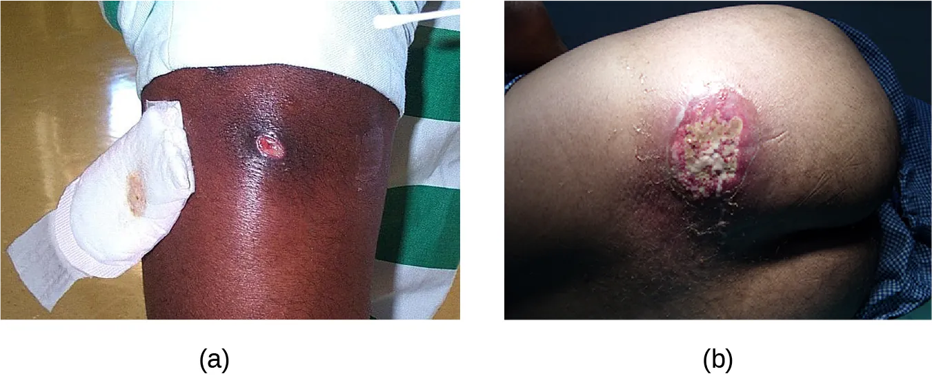 a) a photo of a small inflamed region with a white center. b) A large lesion with white and red.
