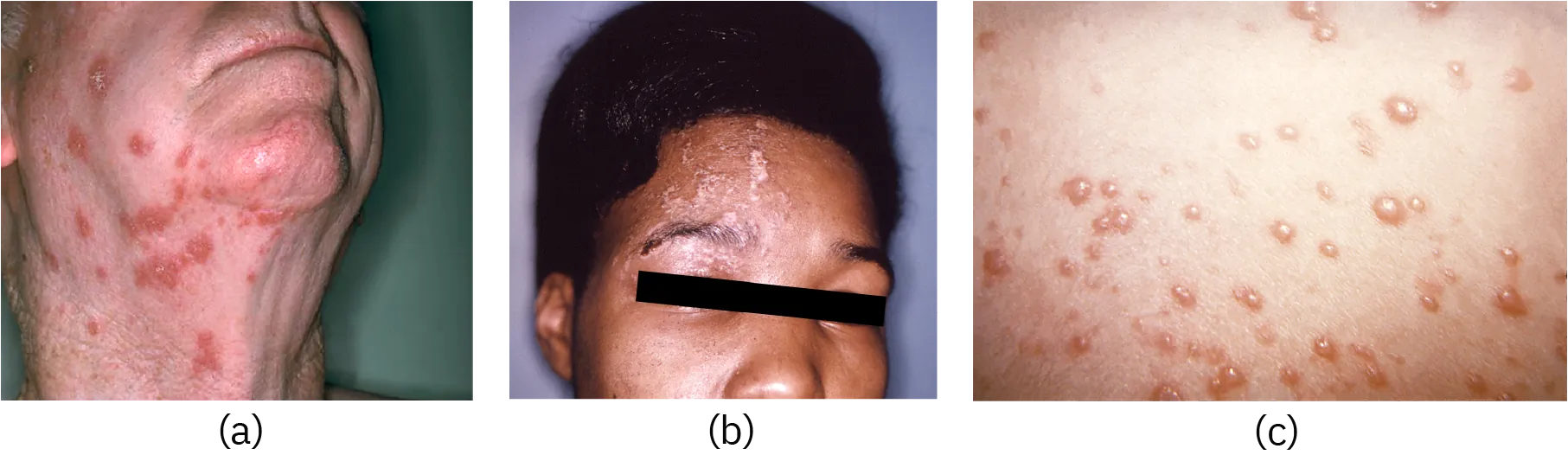 a) Large red spots on an adult’s neck. b) Bumps on an adult's face. c) Red bumps on skin.