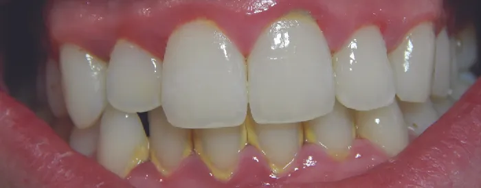 Photo of teeth with yellowing and red inflamed gums.