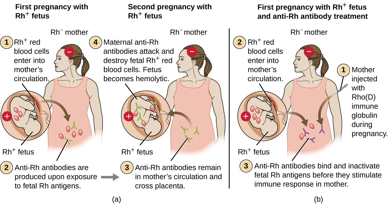 a) First pregnancy with Rh+ fetus resulting in healthy newborn. The diagram shows an Rh- mother and an Rh+ fetus. Rh+ red blood cells cross the placenta into mother’s circulation. This causes anti-Rh antibodies to be produced in the mother upon exposure to fetal Rh antigens. The second pregnancy with Rh+ fetus results in hemolytic newborn. The diagram shows an Rh- mother with an Rh+ fetus. Anti-Rh antibodies remain in mother’s circulation from the first pregnancy and cross the placenta. Maternal anti-Rh antibodies attack and destroy fetal Rh+ red blood cells. B) First pregnancy with Rh+ fetus and anti-Rh antibody treatment resulting in healthy newborn The diagram shows an Rh- mother and an Rh+ fetus. Rh+ red blood cells fromt eh fetus clross placenta into mother’s circulation. Anti-Rh antibodies (Rhogam) bind and inactivate fetal Rh antigens before they stimulate immune response in mother.