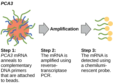 The PCA3 test occurs in three steps. In step one, PCA3 mRNA anneals to complementary DNA primers that are attached to beads. In step two, the mRNA is amplified using reverse-transcriptase PCR. In step three, the mRNA is detected using a chemiluminescent probe.