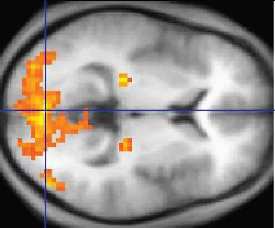This MRI image shows a grainy computer readout of a cross section of the brain. The anterior side of the brain, located on the right hand side of the image, has a large area lighting up with yellow, indicating neural stimulation. Two smaller regions at the center of the brain are also yellow. The two small areas are in the same relative location but in opposite hemispheres of the brain.