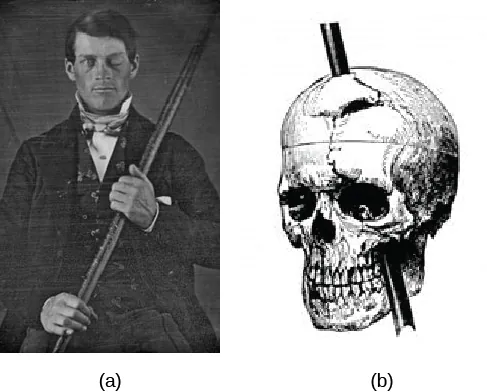 Image (a) is a photograph of Phineas Gage holding a metal rod. Image (b) is an illustration of a skull with a metal rod passing through it from the cheek area to the top of the skull.