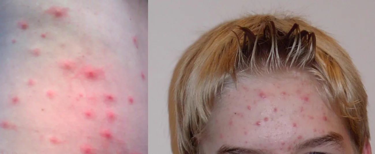 A photo of a person with acne on their forehead; also a close-up.