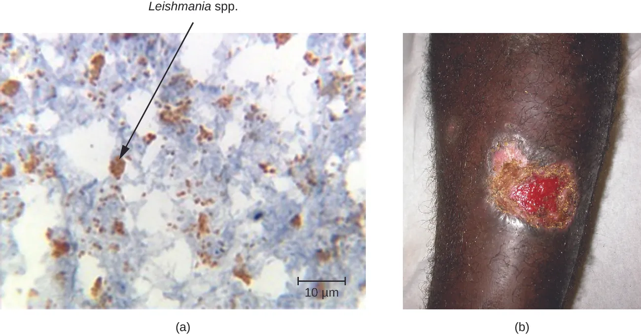 a) Micrograph of a tissue sample. A black arrow points to leishmania mexicana. B) a large, open wound on skin.