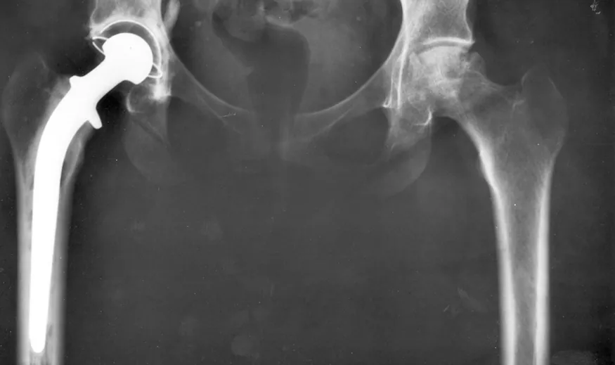 An x-ray image of a person’s hips. The right hip joint (on the left in the photograph) has been replaced. A metal prosthesis is cemented in the top of the right femur and the head of the femur has been replaced by the rounded head of the prosthesis. A white plastic cup is cemented into the acetabulum to complete the two surfaces of the artificial ball and socket joint.