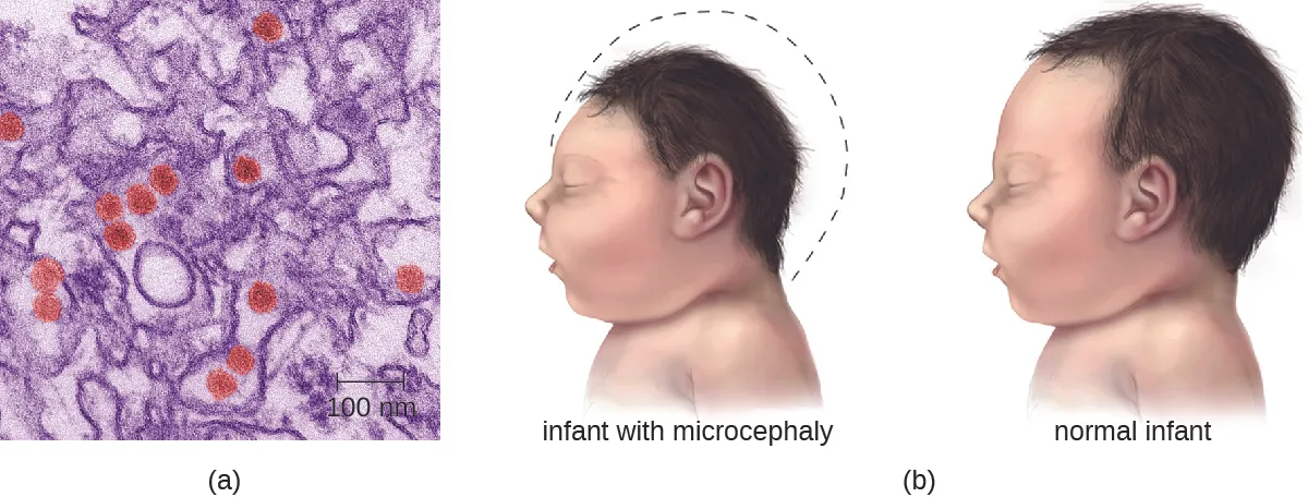 a) Electron micrograph of brown circles in a purple background. B) drawing of infant with smaller head than average; this is especially apparent in the back of the cranial vault.