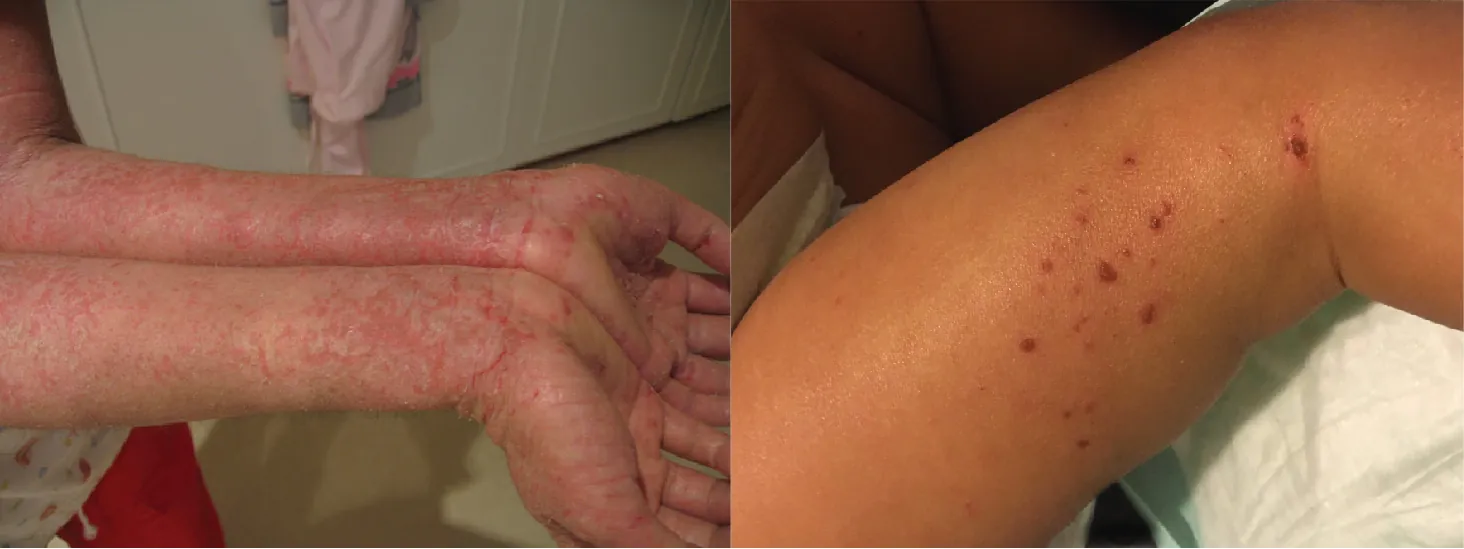 This photo shows a person with eczema on the ventral skin of the forearms. The person is White, but his or her light skin is mottled with many red marks, giving it the appearance of a rash. In some areas, the skin is breaking and peeling.