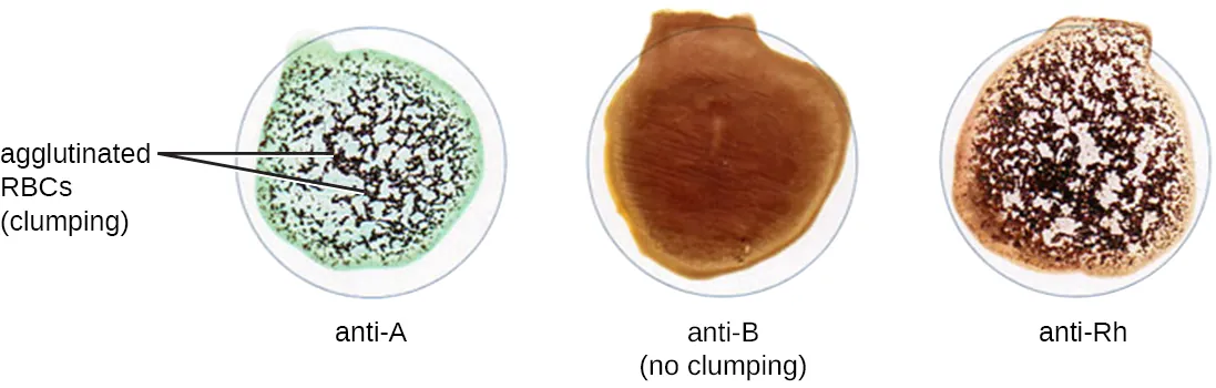 Three wells the first well (labeled anti-A) shows black spots and is labeled clumping. This is due to the agglutinated RBCs. The second well (labeled anti-B) looks smooth and has no clumping. The third well (labeled) anti-Rh shows clumping because it has spots.